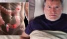 Jasný příznak rakoviny tlustého střeva, který se zhoršuje v noci