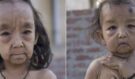 Indický bratr a sestra se podobají malým starým lidem: Hrůzný příběh sourozenců