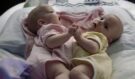 Siamská dvojčata rozdělená po půl roce od narození: Jak vypadají a žijí dnes?