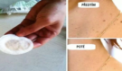 Zbavte se bradavic i nevzhledných výrůstků? Internet miluje „zázračný“ přírodní recept. Dermatologové však varují