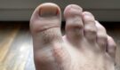 Vypadají vaše prsty na nohou takto? Pak máte vážný problém, o kterém ještě nevíte!
