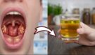 Neuvěřitelná síla cibule a hřebíčku: Domácí recept, který zatočí s angínou a bolestí v krku během pár hodin!