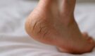 Dermatolog varuje: Popraskané paty nejsou jen kosmetika! Jak je rychle zachránit bez drahé kosmetiky?
