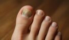 Plísně na nehtech mizí: Domácí recepty z kuchyně, které dermatologové neradi slyší