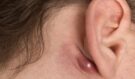 Tukové cysty za uchem a na krku: Kdy stačí babské rady a kdy utíkat k lékaři?