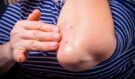 Aloe vera pod drobnohledem: Zázračná rostlina proti ekzému, lupénce i akné