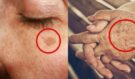 Pigmentové a stařecké skvrny mizí ze scény: 4 klíčové vitaminy, které dermatologové doporučují