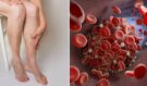 Oteklé nohy, bolest a zarudnutí: Varovný signál krevní sraženiny, která může zabíjet. Poznáte včas příznaky trombózy?