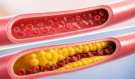 Nejsilnější přírodní lék na cholesterol, který máte možná doma. Věděli jste, co všechno dokáže?