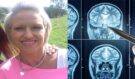 Lékaři jí měsíce tvrdili, že jde o menopauzu. Pak přišla krutá diagnóza nádoru na mozku a zoufalý plán