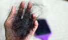 Padají vám vlasy, bolí klouby a otékáte? Lupus může dlouho klamat – a ženy jsou v největším riziku