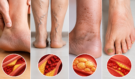 Lékaři varují: Pokud na nohách zpozorujete tyto 4 změny, nechte si zkontrolovat cholesterol